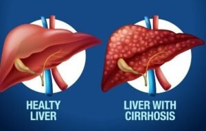 Best Liver Cirrhosis Intervention in Faridabad