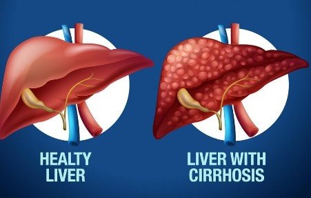 Best Liver Cirrhosis Intervention in Faridabad