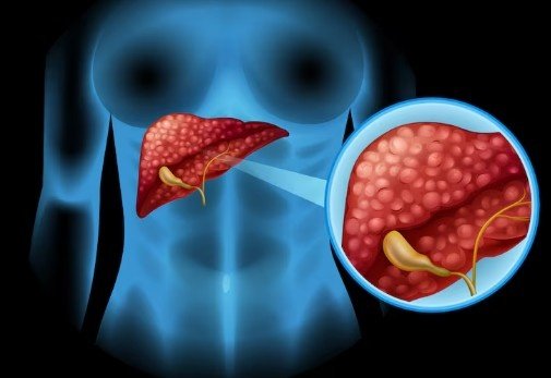 Interventional Radiology for Liver Tumor in Faridabad