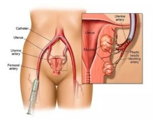 Uterine Fibroid Embolisation in Faridabad