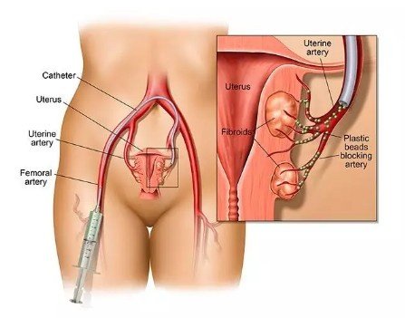 Uterine Fibroid Embolisation in Faridabad