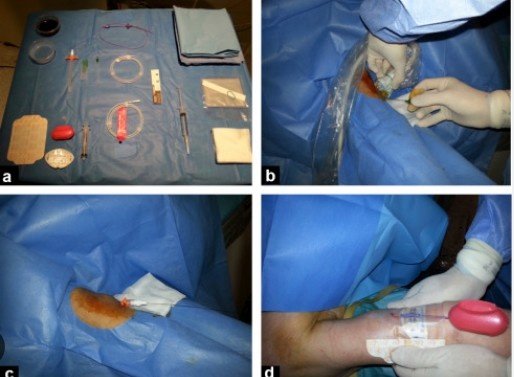 PICC Line Insertion by Interventional Radiologist in Faridabad