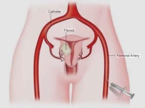 Best Fibroid Treatment (UFE) in Sector 16, Faridabad