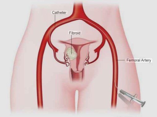 Best Fibroid Treatment (UFE) in Sector 16, Faridabad