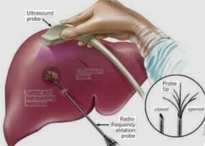 Tumor Ablation Treatment in Faridabad