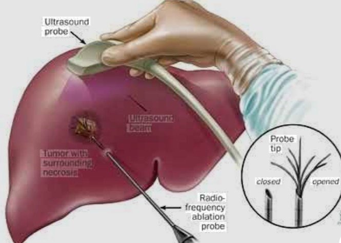 Tumor Ablation Treatment in Faridabad