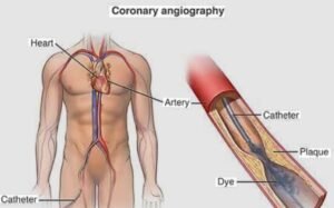 Angiography Test in Faridabad