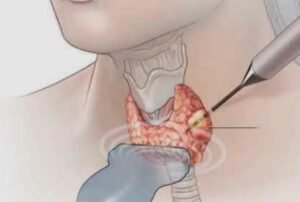 Best Thyroid Nodule Treatment Doctors in Faridabad
