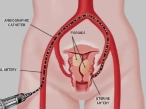 Uterine Artery Embolisation in Sector 48, Faridabad
