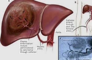 Best Liver Tumor Treatment in Faridabad