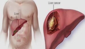Liver Cancer Treatment in Faridabad
