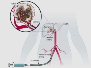 Best Liver Tumour Treatment in Faridabad