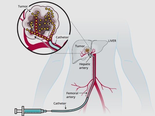 Best Liver Tumour Treatment in Faridabad