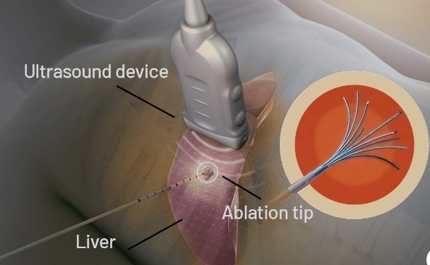 Best interventions for oncology in Faridabad