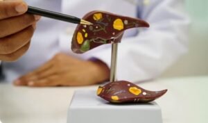 Liver Cirrhosis Treatment in Faridabad