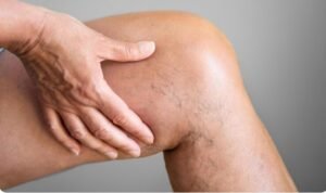 Best Varicose vein Treatment in Faridabad