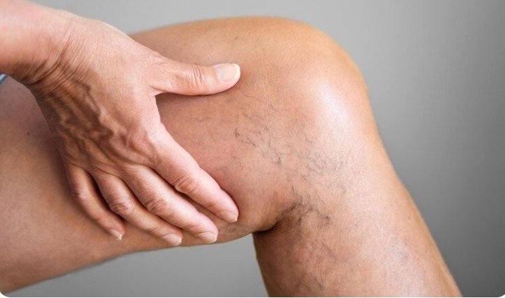 Best Varicose vein Treatment in Faridabad