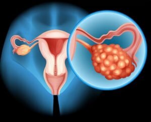 Best Adenomyosis Embolisation Treatment in Faridabad