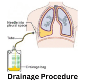 Drainage Procedure Treatment in Gurgaon