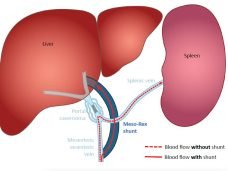 65dfbe6c20316e5adb61d7fePortalHypertension2
