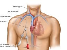 Central-venous-catheter-1