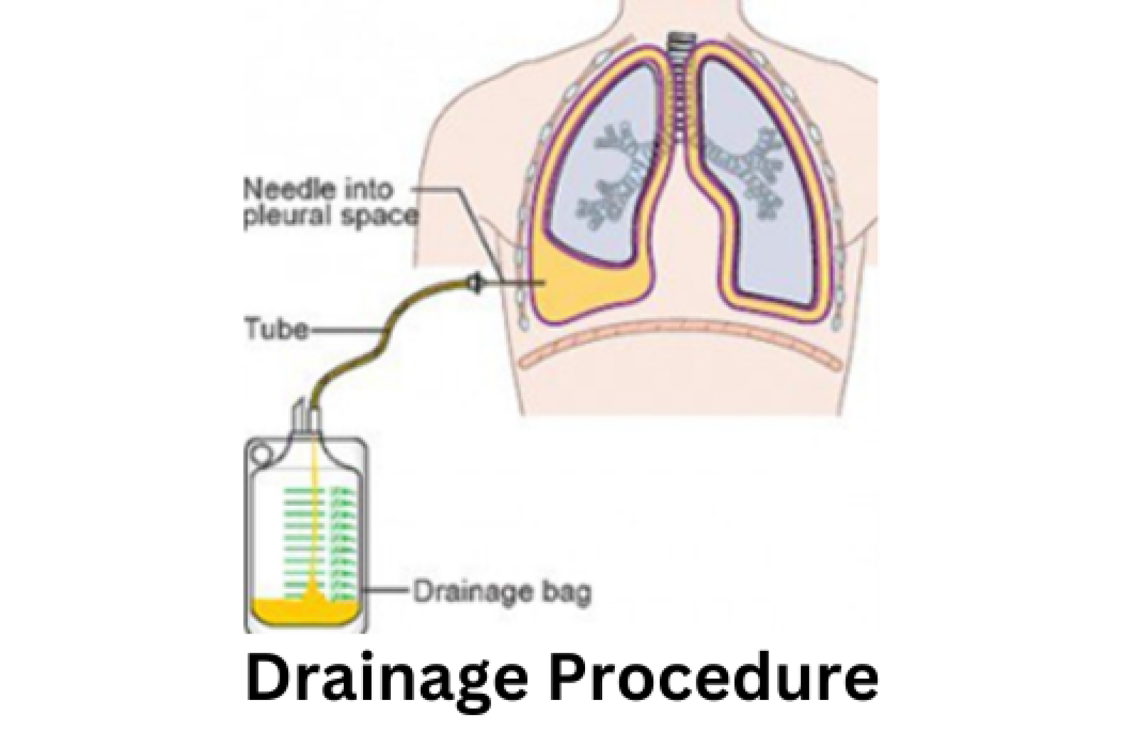 Liver-Cirrhosis-And-PHT-1