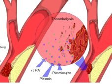 Treatment-2-Thrombolysis-mechanical-thrombectomy-for-acute-arterial-thrombosis1