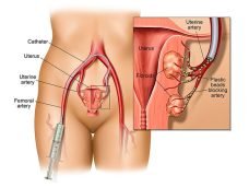 Uterine-Fibroid-Embolization