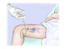 Vascular_malformation2