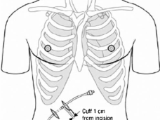deal-location-of-the-tunnelled-drain-indicating