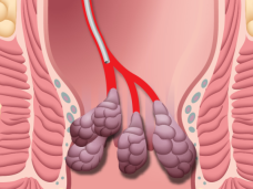 hae-interventional-radiology-illo-pre