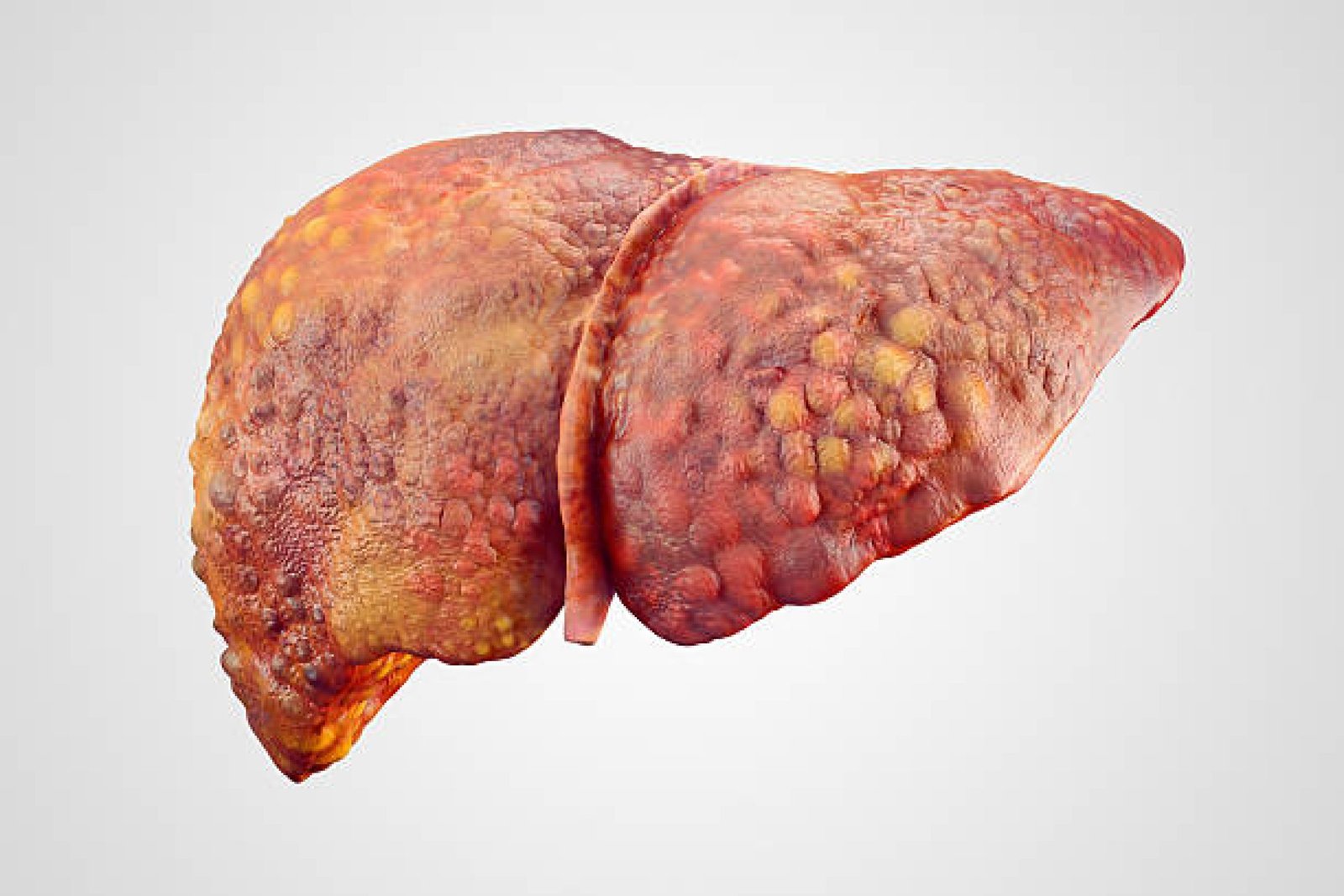 Liver Cirrhosis Treatment in Faridabad