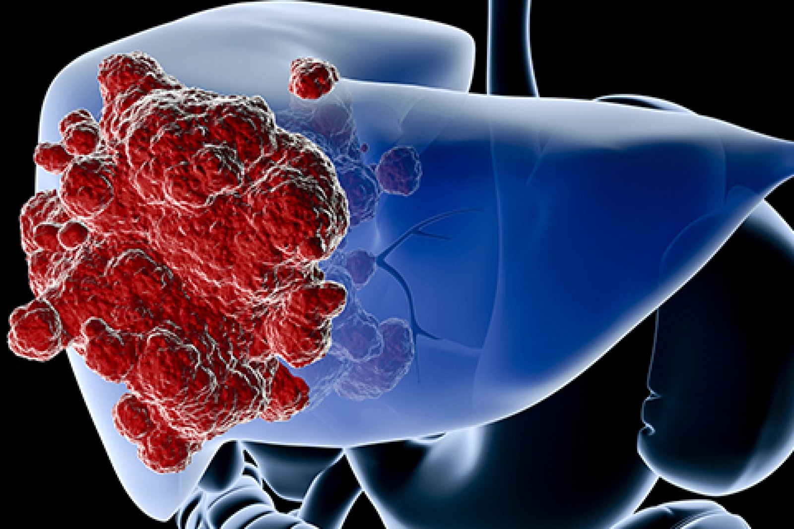 Digital medical illustration: Perspective x-ray view of human liver with tumor. Anatomically correct. Isolated on black.